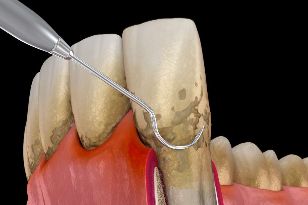 船越歯周病学研修会 講師 幅広い歯周病治療をご提供